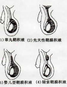 促使产生鞘膜积液的原因